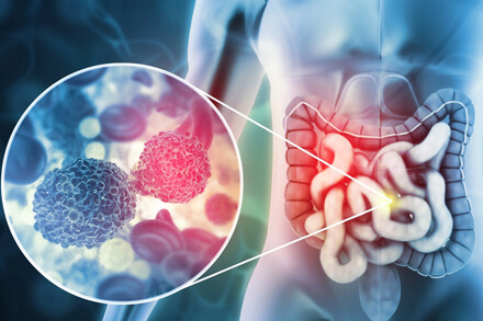 Ilustración del cáncer colorrectal con figura humana y detalle del intestino donde se observan células cancerígenas ampliadas — investigación científica sobre el virus AR2015 del CONICET y la Fundación Instituto Leloir.