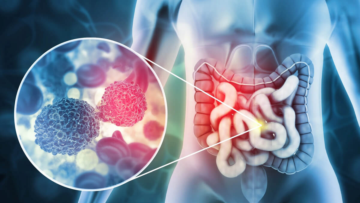 Ilustración del cáncer colorrectal con figura humana y detalle del intestino donde se observan células cancerígenas ampliadas — investigación científica sobre el virus AR2015 del CONICET y la Fundación Instituto Leloir.